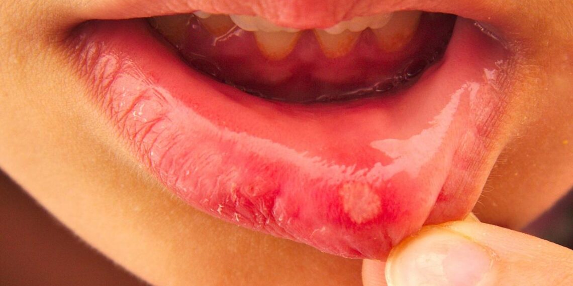 Identify whether the blisters in the mouth are ulcers or cancer