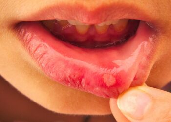 Identify whether the blisters in the mouth are ulcers or cancer