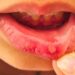 Identify whether the blisters in the mouth are ulcers or cancer